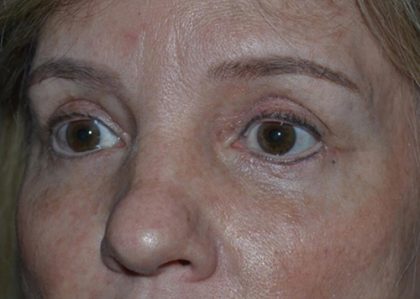 Blepharoplasty Before & After Patient #20131