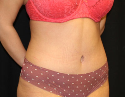 Tummy Tuck Before & After Patient #19856