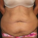 Tummy Tuck Before & After Patient #19856