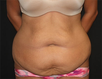 Tummy Tuck Before & After Patient #19856