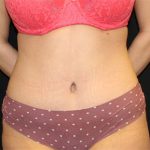 Tummy Tuck Before & After Patient #19856