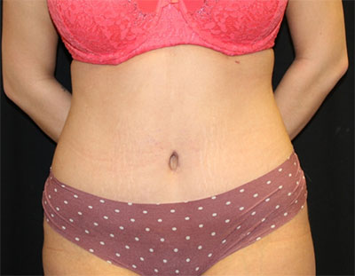 Tummy Tuck Before & After Patient #19856