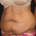 Tummy Tuck Before & After Patient #19856