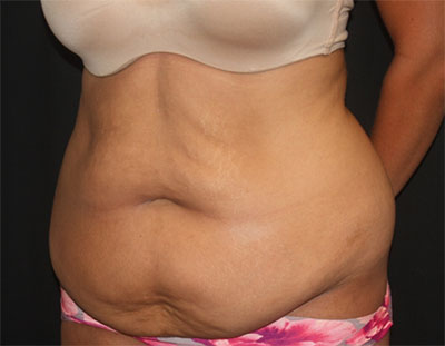 Tummy Tuck Before & After Patient #19856