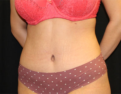 Tummy Tuck Before & After Patient #19856