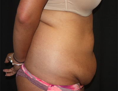 Tummy Tuck Before & After Patient #19856