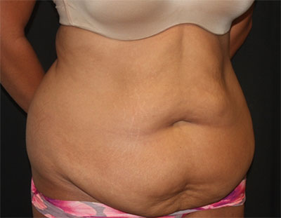 Tummy Tuck Before & After Patient #19856