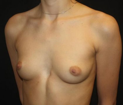 Breast Augmentation - Round Silicone Implants Before & After Patient #20367