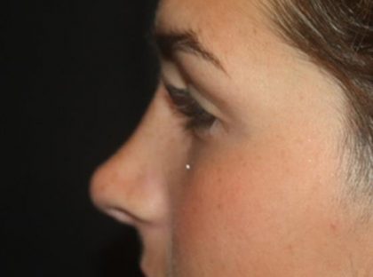 Rhinoplasty Before & After Patient #21780