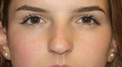 Rhinoplasty Before & After Patient #21780