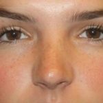 Rhinoplasty Before & After Patient #21780