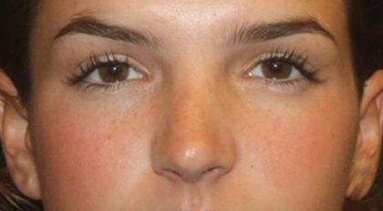 Rhinoplasty Before & After Patient #21780