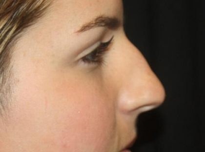 Rhinoplasty Before & After Patient #21780