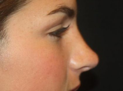 Rhinoplasty Before & After Patient #21780