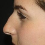 Rhinoplasty Before & After Patient #21780