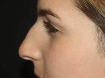 Rhinoplasty Before & After Patient #21780