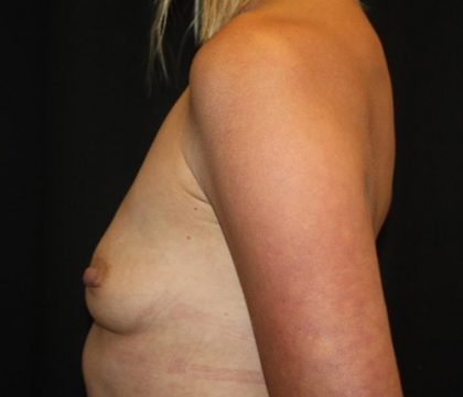 Breast Augmentation - Round Silicone Implants Before & After Patient #20366