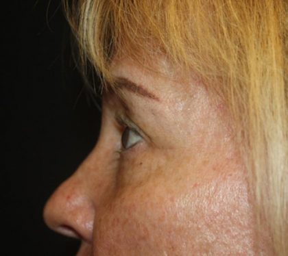 Blepharoplasty Before & After Patient #20131