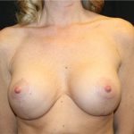 Breast Lift with Implant Before & After Patient #20771