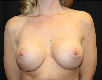 Breast Lift with Implant Before & After Patient #20771