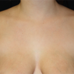 Axillary Breast Tissue – Removal Before & After Patient #20035