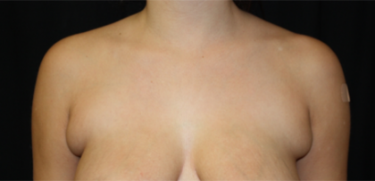 Axillary Breast Tissue – Removal Before & After Patient #20035