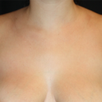 Axillary Breast Tissue – Removal Before & After Patient #20035