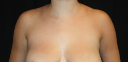 Axillary Breast Tissue – Removal Before & After Patient #20035