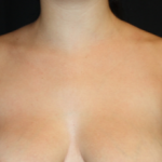 Axillary Breast Tissue – Removal Before & After Patient #20035