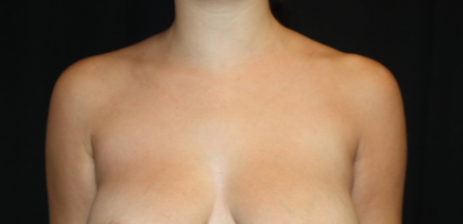 Axillary Breast Tissue – Removal Before & After Patient #20035