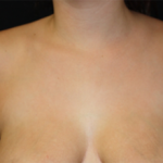 Axillary Breast Tissue – Removal Before & After Patient #20035