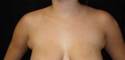 Axillary Breast Tissue – Removal Before & After Patient #20035