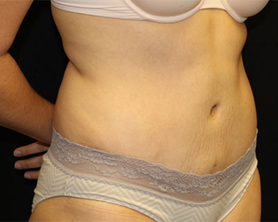 Tummy Tuck Before & After Patient #19834