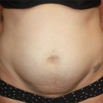 Tummy Tuck Before & After Patient #19834