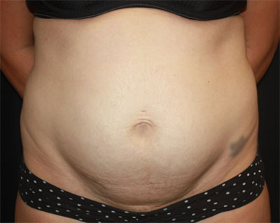 Tummy Tuck Before & After Patient #19834