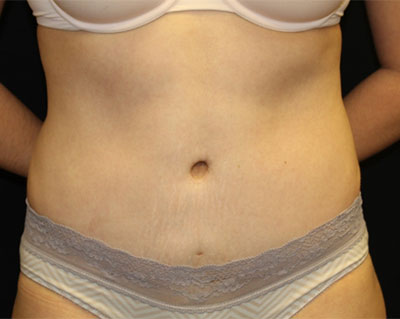 Tummy Tuck Before & After Patient #19834