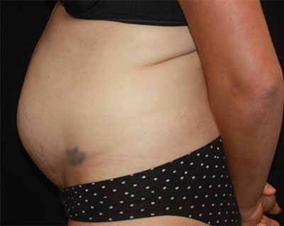 Tummy Tuck Before & After Patient #19834