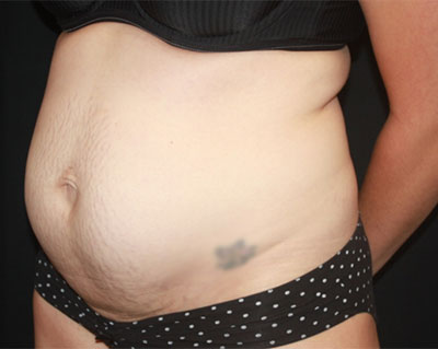 Tummy Tuck Before & After Patient #19834