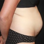 Tummy Tuck Before & After Patient #19834