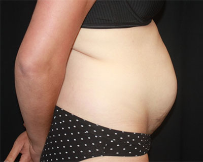 Tummy Tuck Before & After Patient #19834