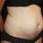 Tummy Tuck Before & After Patient #19834