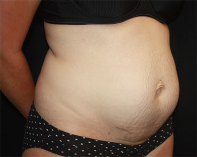 Tummy Tuck Before & After Patient #19834