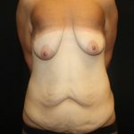 Breast Lift with Implant Before & After Patient #20770