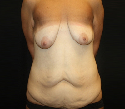 Breast Lift with Implant Before & After Patient #20770