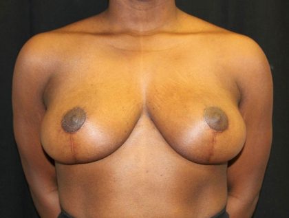 Breast Reduction Before & After Patient #20997