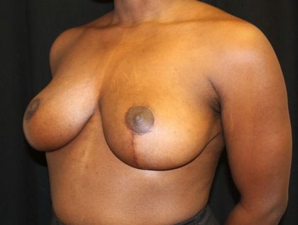 Breast Reduction Before & After Patient #20997