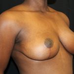 Breast Reduction Before & After Patient #20997