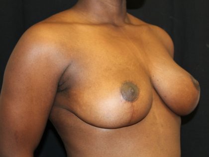 Breast Reduction Before & After Patient #20997