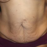 Tummy Tuck Before & After Patient #19878