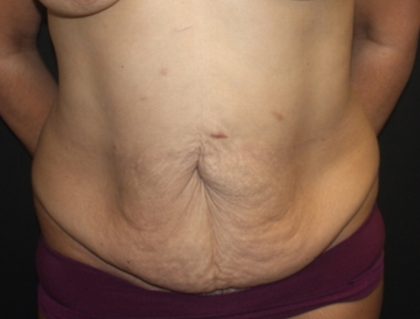 Tummy Tuck Before & After Patient #19878